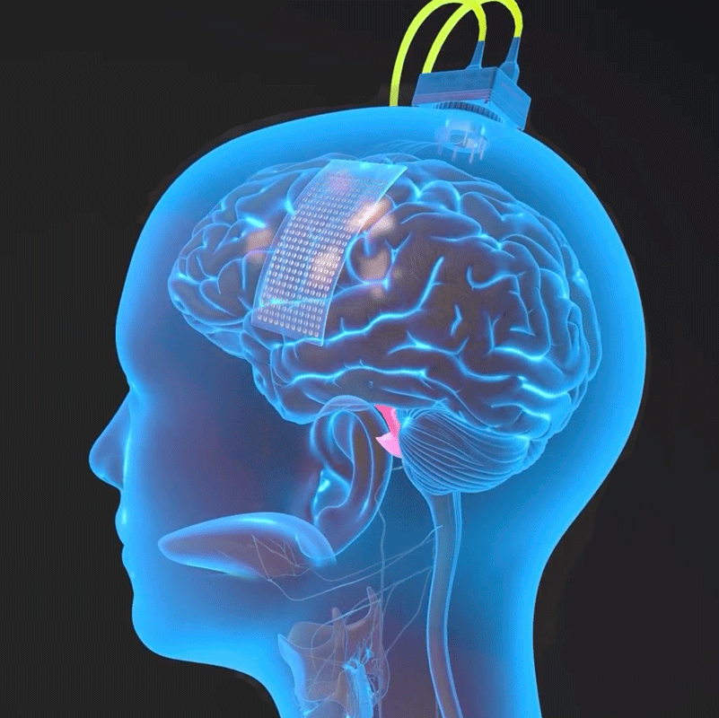 Brain-Computer Interface and AI enable paralysed woman to talk again