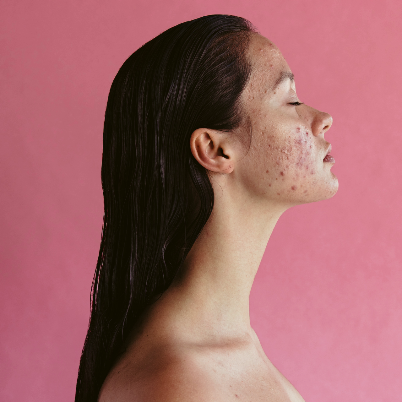 Tiny nanocarriers could prove the magic bullet for acne sufferers