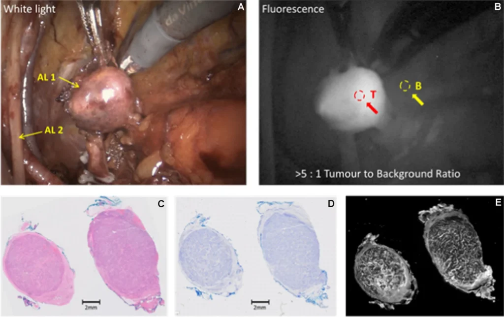 Patient 15 prostate tumor highlighted with flourescence. Credit: Cancer Research UK/European Journal of Nuclear Medicine and Molecular Imaging. Article: Glowing dye helps surgeons eradicate prostate cancer.