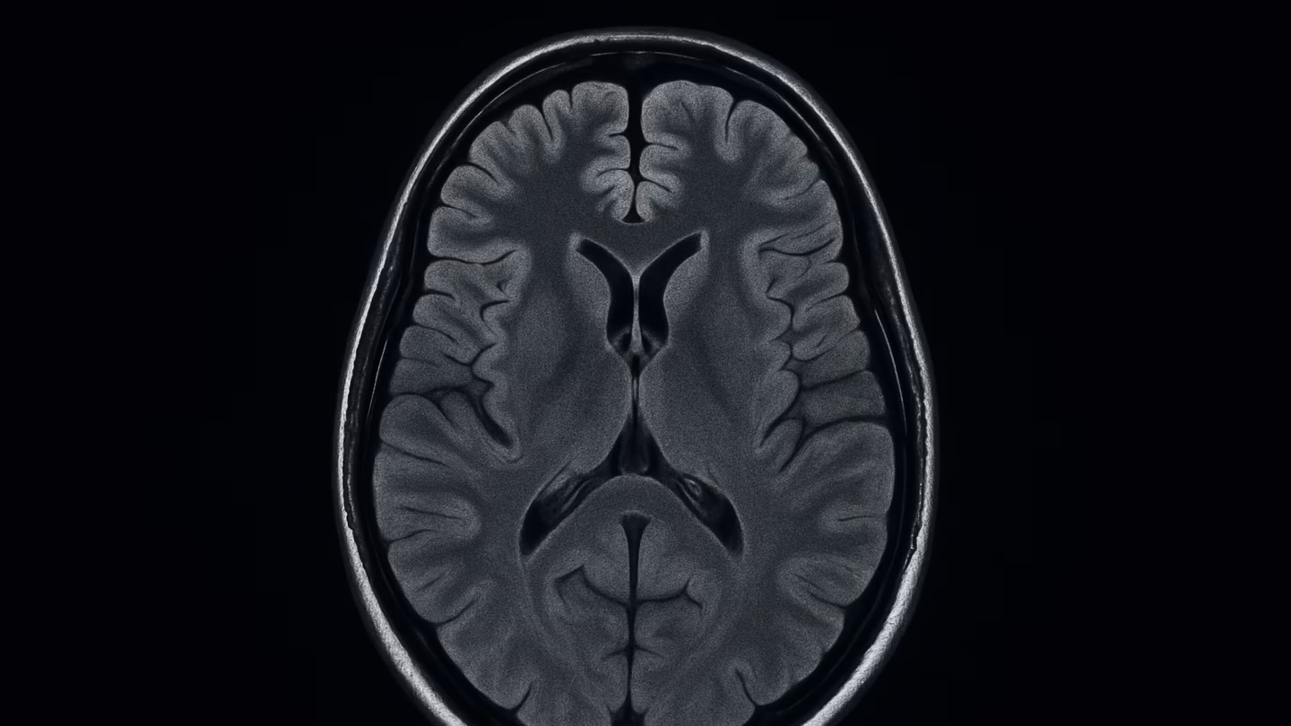 Brain scans may soon predict best antidepressant for you