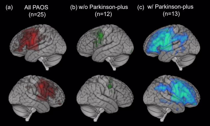 PET imaging links brain inflammation to speech disorder and Parkinson-like syndrome